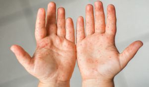 Enfermedad boca-mano-pie: qué hacer ante un contagio y cuáles son sus señales de alerta